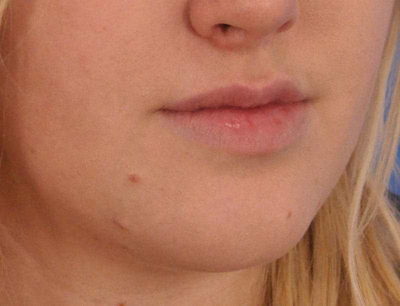Lip Filler Before & After Gallery - Patient 377965 - Image 4