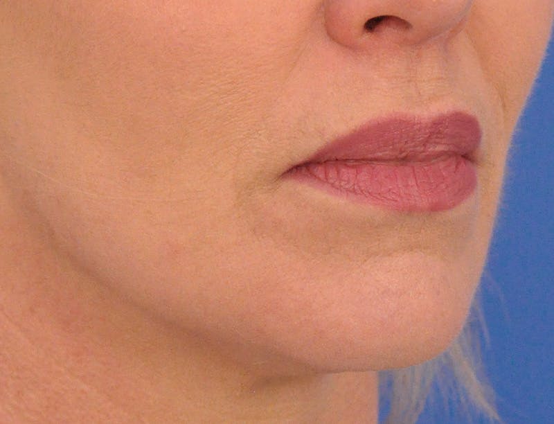 Lip Filler Before & After Gallery - Patient 399369 - Image 4