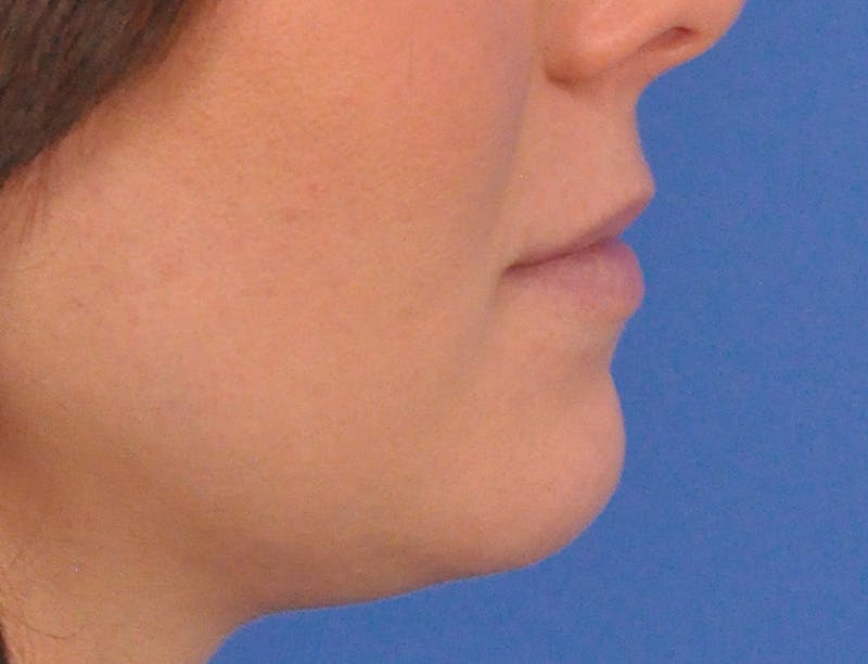 Lip Filler Before & After Gallery - Patient 788567 - Image 5
