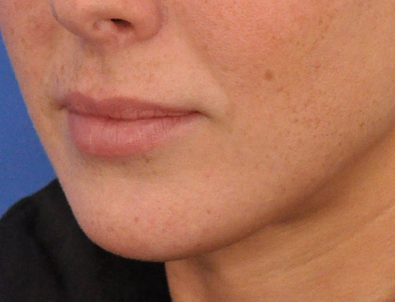 Lip Filler Before & After Gallery - Patient 144651 - Image 7