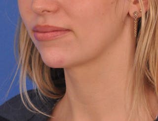 Chin Filler Before & After Gallery - Patient 144543 - Image 8