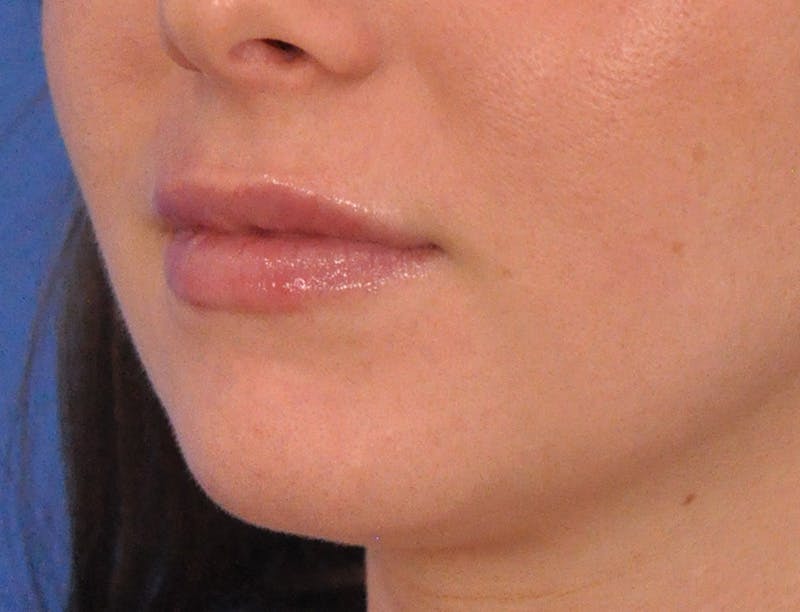 Lip Filler Before & After Gallery - Patient 788567 - Image 8