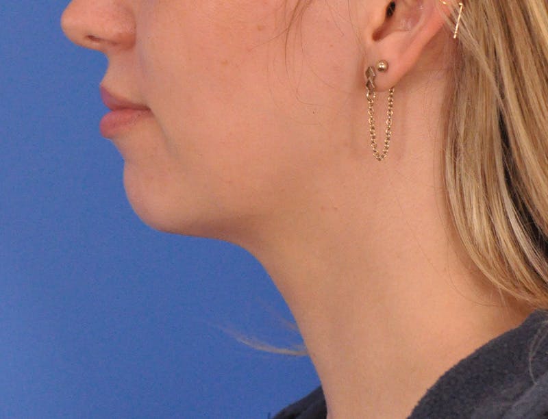 Chin Filler Before & After Gallery - Patient 144543 - Image 9