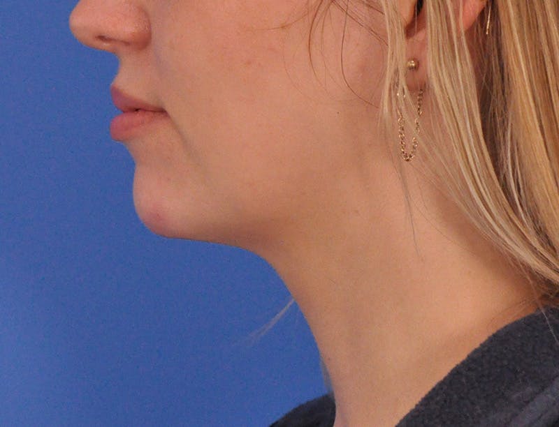 Chin Filler Before & After Gallery - Patient 144543 - Image 10