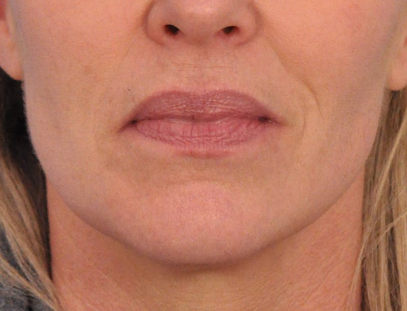 Lip Filler Before & After Gallery - Patient 399369 - Image 1