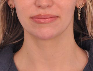 Chin Filler Before & After Gallery - Patient 144543 - Image 6