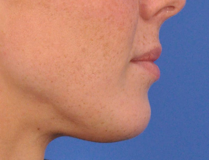 Lip Filler Before & After Gallery - Patient 144651 - Image 5