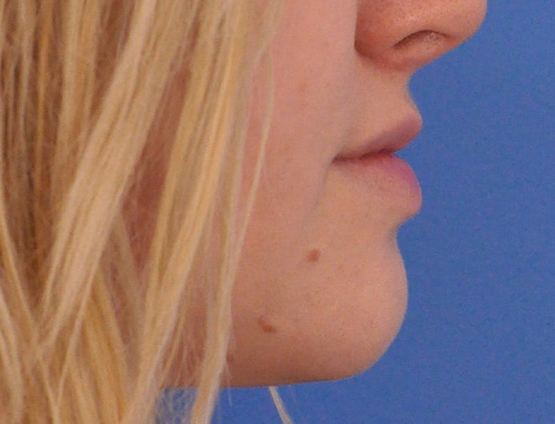 Lip Filler Before & After Gallery - Patient 377965 - Image 5