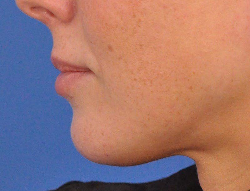 Lip Filler Before & After Gallery - Patient 144651 - Image 9