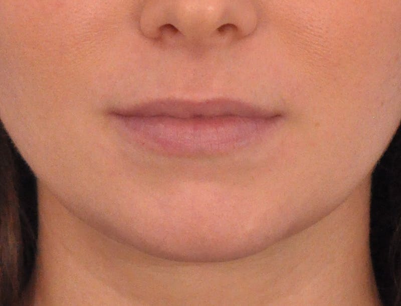 Lip Filler Before & After Gallery - Patient 788567 - Image 1
