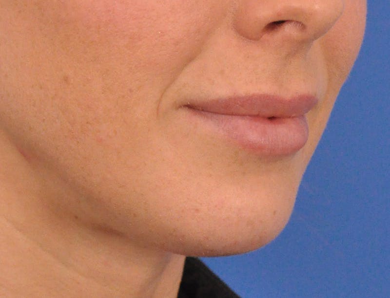 Lip Filler Before & After Gallery - Patient 144651 - Image 4