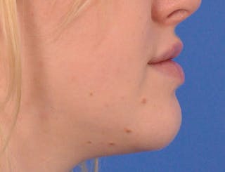 Lip Filler Before & After Gallery - Patient 377965 - Image 6