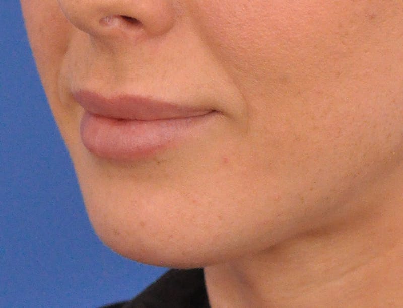 Lip Filler Before & After Gallery - Patient 144651 - Image 8