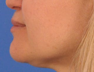 Lip Filler Before & After Gallery - Patient 844472 - Image 10