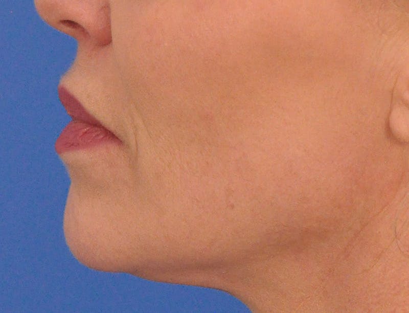 Lip Filler Before & After Gallery - Patient 399369 - Image 10