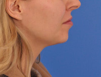 Chin Filler Before & After Gallery - Patient 399856 - Image 2
