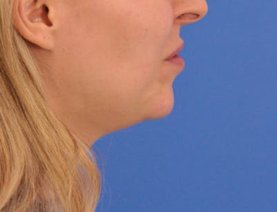 Chin Filler Before & After Gallery - Patient 399856 - Image 1