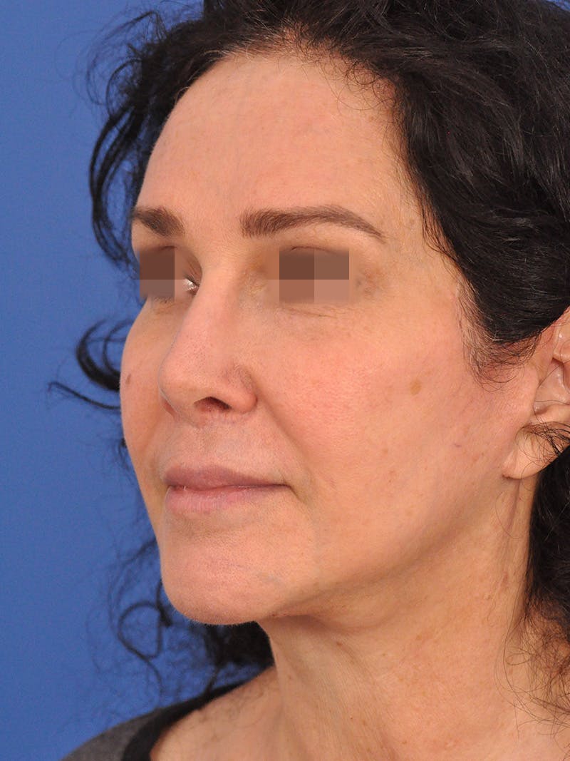 Lip Lift Before & After Gallery - Patient 124863 - Image 8