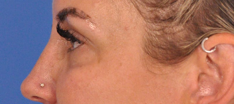 Blepharoplasty Before & After Gallery - Patient 553105 - Image 9