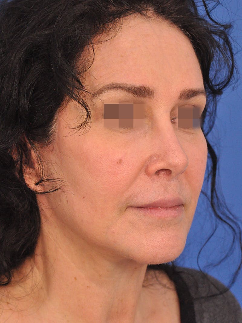 Lip Lift Before & After Gallery - Patient 124863 - Image 4