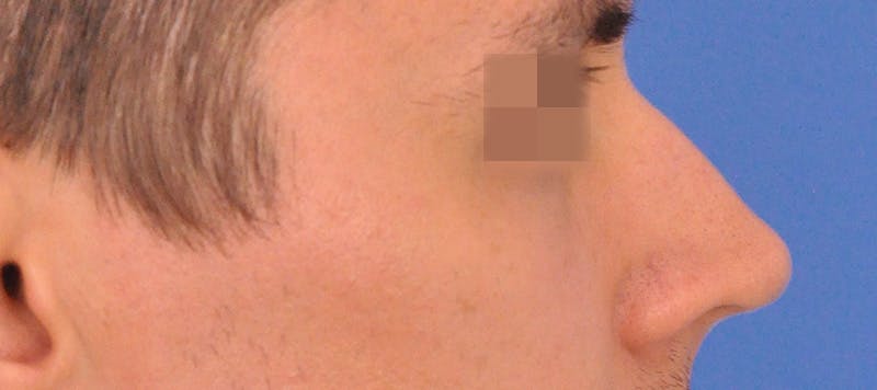 Rhinoplasty Before & After Gallery - Patient 373430 - Image 1