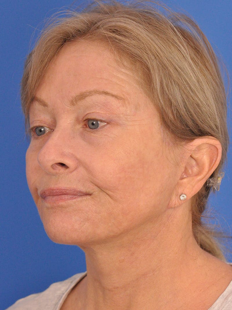 Facelift Before & After Gallery - Patient 344965 - Image 8