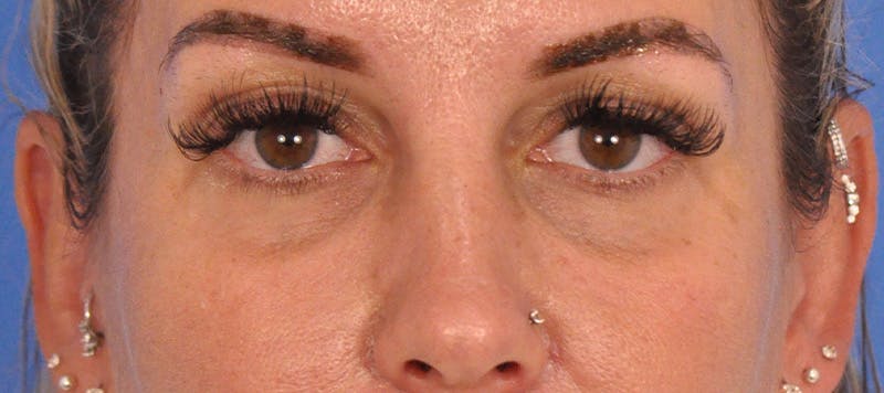 Blepharoplasty Before & After Gallery - Patient 553105 - Image 1