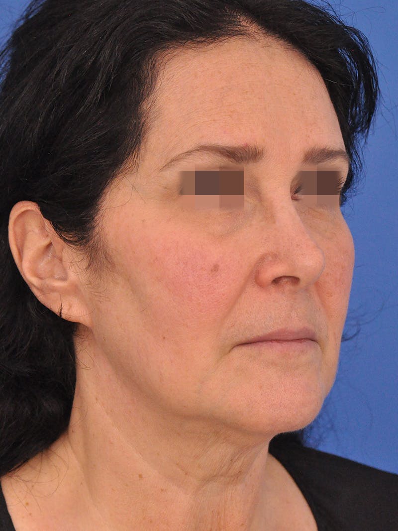 Lip Lift Before & After Gallery - Patient 124863 - Image 3