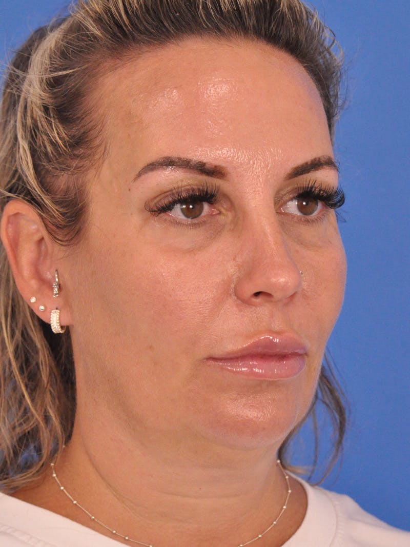 Facelift Before & After Gallery - Patient 401988 - Image 3