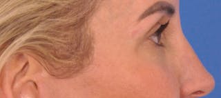 Blepharoplasty Before & After Gallery - Patient 553105 - Image 6