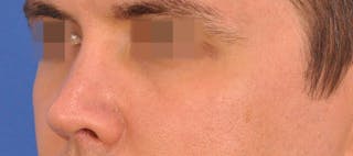 Rhinoplasty Before & After Gallery - Patient 373430 - Image 8