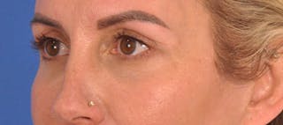 Blepharoplasty Before & After Gallery - Patient 553105 - Image 8
