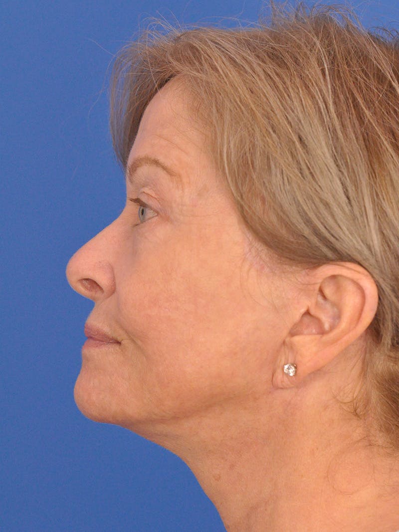 Facelift Before & After Gallery - Patient 344965 - Image 10