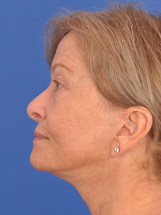 Neck Lift Before & After Gallery - Patient 567213 - Image 10