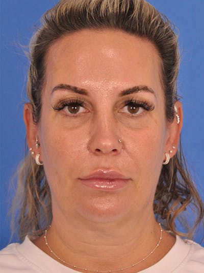 Facelift Before & After Gallery - Patient 401988 - Image 1