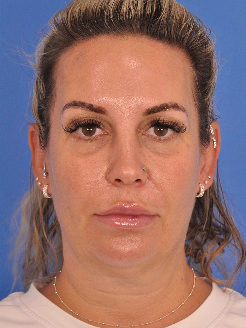 Facelift Before & After Gallery - Patient 401988 - Image 1