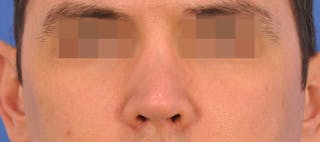 Rhinoplasty Before & After Gallery - Patient 373430 - Image 6