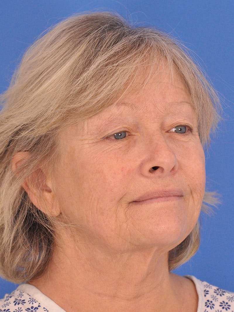Facelift Before & After Gallery - Patient 344965 - Image 3