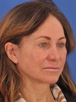 Neck Lift Before & After Gallery - Patient 388526 - Image 4