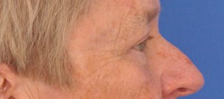 Blepharoplasty Before & After Gallery - Patient 874712 - Image 6