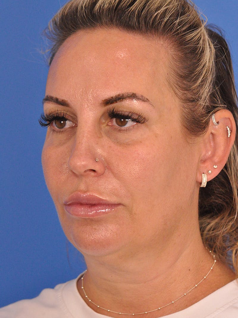 Facelift Before & After Gallery - Patient 401988 - Image 7
