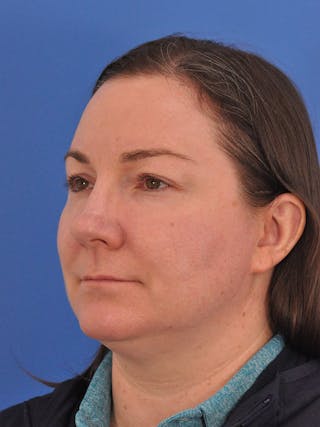 CO2RE Laser Before & After Gallery - Patient 350454 - Image 8