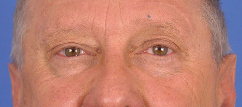 Blepharoplasty Before & After Gallery - Patient 355493 - Image 2