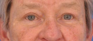 Blepharoplasty Before & After Gallery - Patient 874712 - Image 2