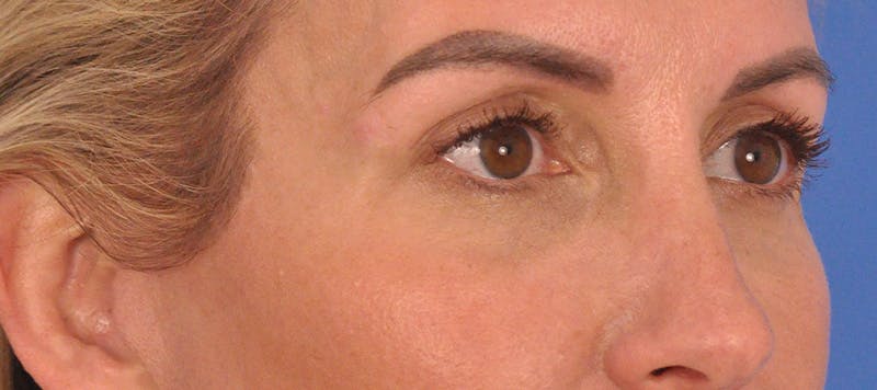 Blepharoplasty Before & After Gallery - Patient 553105 - Image 4