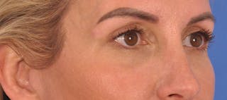 Blepharoplasty Before & After Gallery - Patient 553105 - Image 4