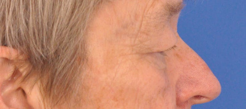 Blepharoplasty Before & After Gallery - Patient 874712 - Image 5