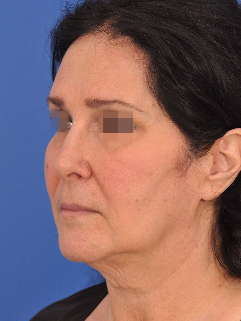 Lip Lift Before & After Gallery - Patient 124863 - Image 7