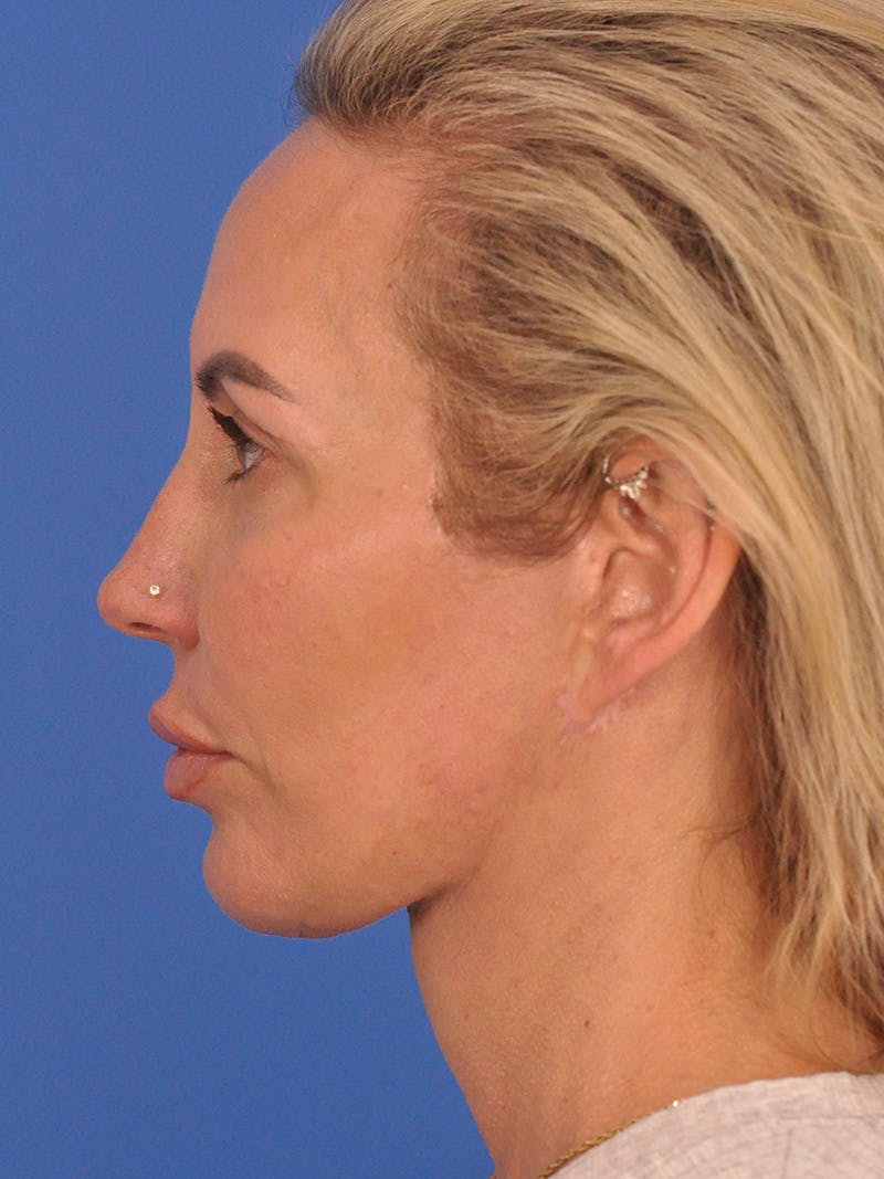 Facelift Before & After Gallery - Patient 401988 - Image 10