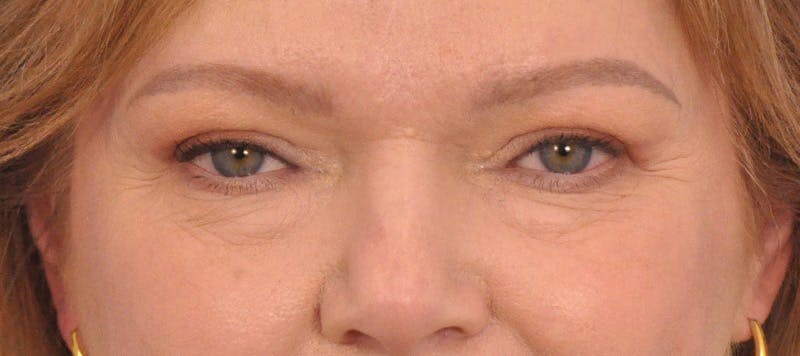 Blepharoplasty Before & After Gallery - Patient 413757 - Image 2